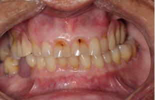 Cómo prevenir las caries desde la infancia