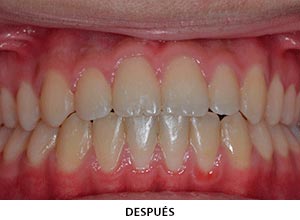 Ortodoncia - Esprohident Clínica Dental en Jerez de la Frontera, Cádiz y Chiclana