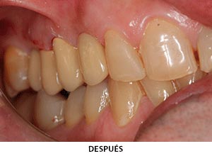 Prótesis dental - Esprohident Clínica Dental en Jerez de la Frontera, Cádiz y Chiclana