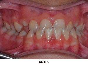 Ortodoncia - Esprohident Clínica Dental en Jerez de la Frontera, Cádiz y Chiclana