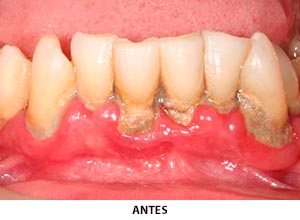 Periodoncia - Esprohident Clínica Dental en Jerez de la Frontera, Cádiz y Chiclana